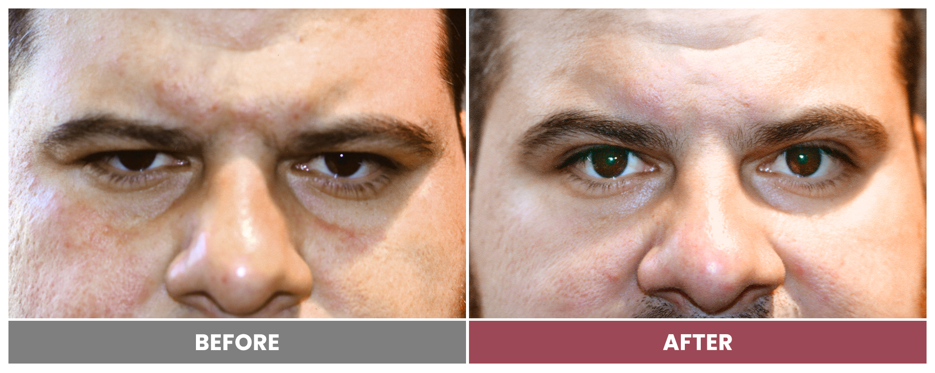 Upper Blepharoplasty - Case 105